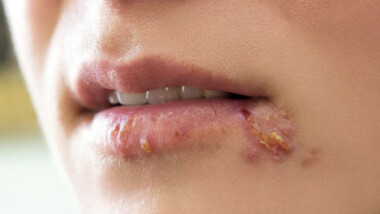 Herpes labial puede contagiar otras partes del cuerpo